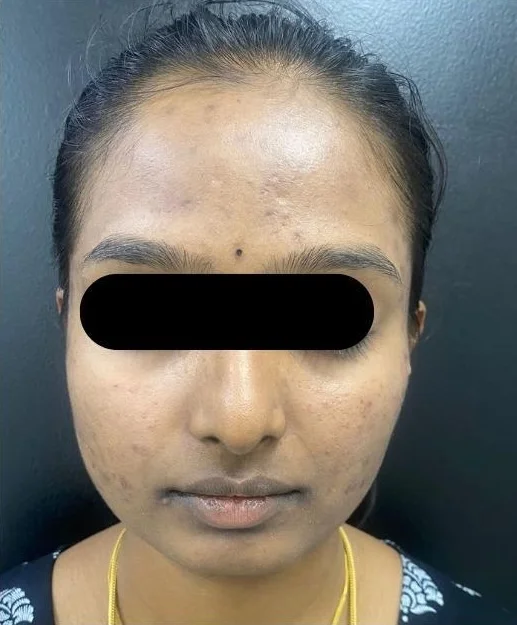 After treatment result 1